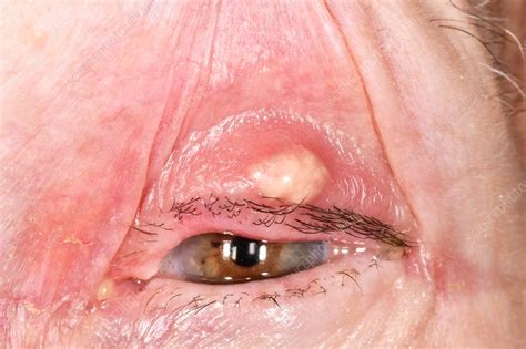 Chalazion Cyst On An Eyelid Stock Image C0381684 Science Photo