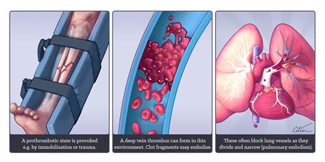 Venous Thromboembolism — Mrinz Medical Research Institute Of New Zealand