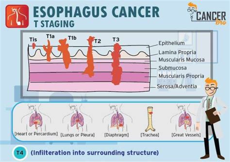 Esophageal Cancer Tnm Staging Explained In Detail Site Title