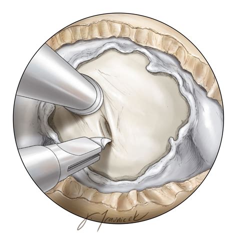 Craniopharyngioma The Neurosurgical Atlas By Aaron Cohen Gadol Md