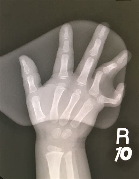 Unusual Extra Finger Congenital Hand And Arm Differences Washington University In St Louis