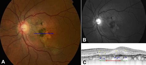 Fundus Photo And Sd Oct Of A Patient With Cnv Secondary To Angioid