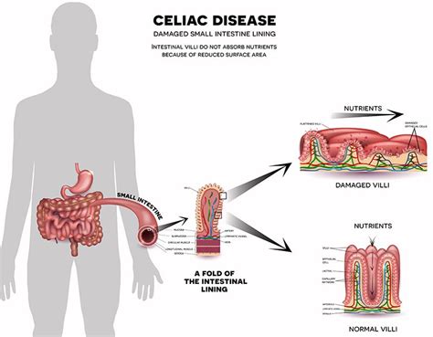What Organ Is Affected By Celiac Disease Pelajaran