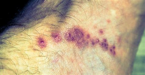 Einige arten von läsionen, die sich entwickeln können, sind herpes. Krätze Symptome Die 18 Anzeichen