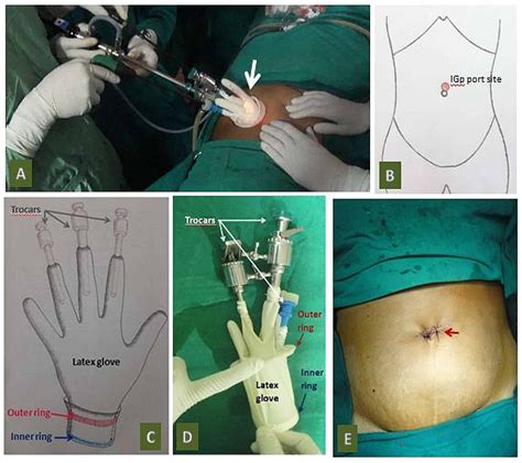 Cureus A Comparative Study Between Single Incision Laparoscopic Appendicectomy Using