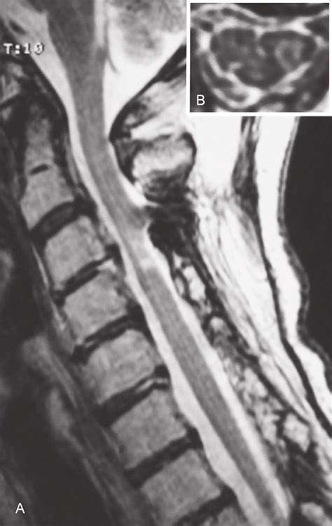 Figure1magnetic Resonance Imaging Of The Cervical Spine Performed 5