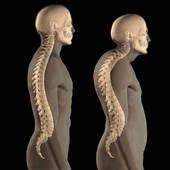 Scheuermann, or scheuermann's, disease (juvenile kyphosis) is a deformity in the thoracic or thoracolumbar spine in which pediatric patients have an increased kyphosis along with backache and. Scheuermann's Disease - Children's Scoliosis Center ...
