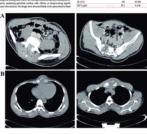 Ct Scan Showing A Mass Involving The Spinal Cord L4 L5l5 S1 And The