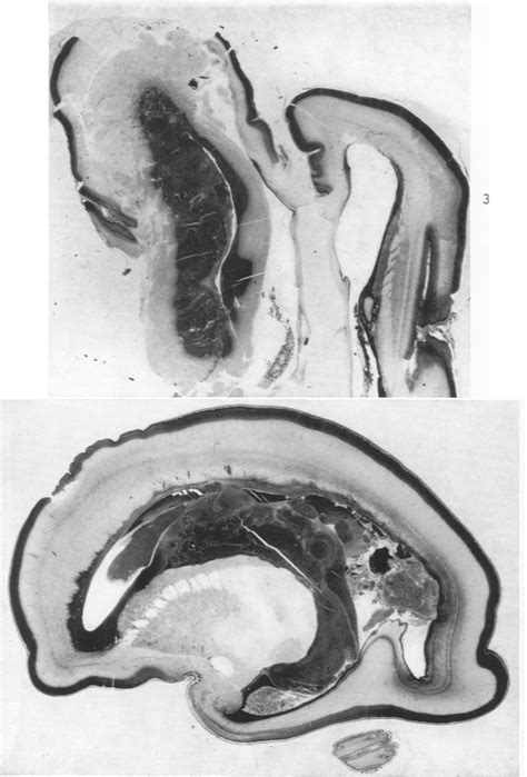 Figure 3 From Cerebral Intraventricular Hemorrhage And Subependymal