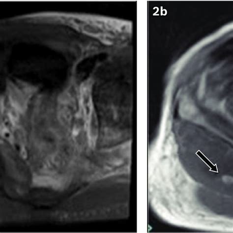 Coronal And Axial Turbo Inversion Recovery Magnitude Mr Imaging