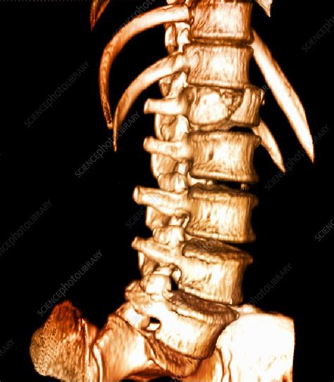 Spinal Injury 3d Ct Scan Stock Image C0370778 Science Photo Library