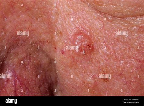 Skin Cancer Basal Cell Carcinoma Bcc Or Rodent Ulcer On The Cheek