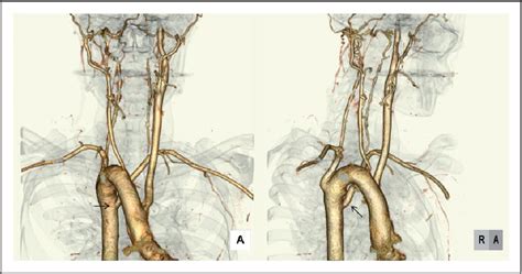 Figure From Left Internal Carotid Artery Agenesis With Trans Sellar Collateral And A Right