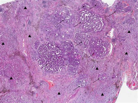 Microscopic Features Of The Metastatic Papillary Thyroid Carcinoma And