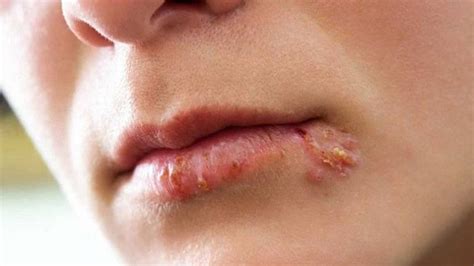 Symptoms And Signs Of Herpes Page 3 Entirely Health