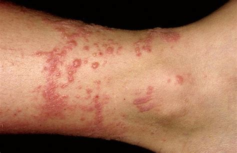 Contact Dermatitis Pictures Symptoms Causes Treatment Hubpages