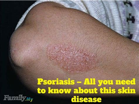Psoriasis All You Need To Know About This Skin Disease Healthcare