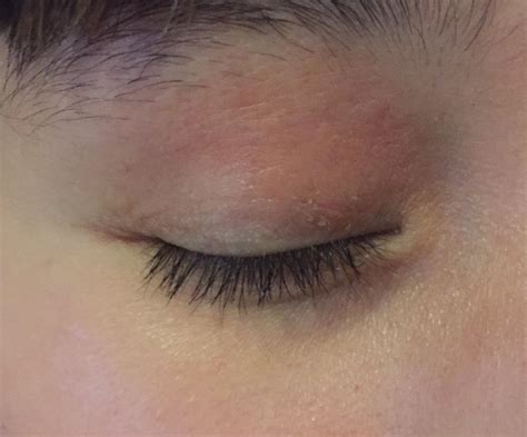 Routine Help Dry Spot On My Eyelid Rskincareaddiction