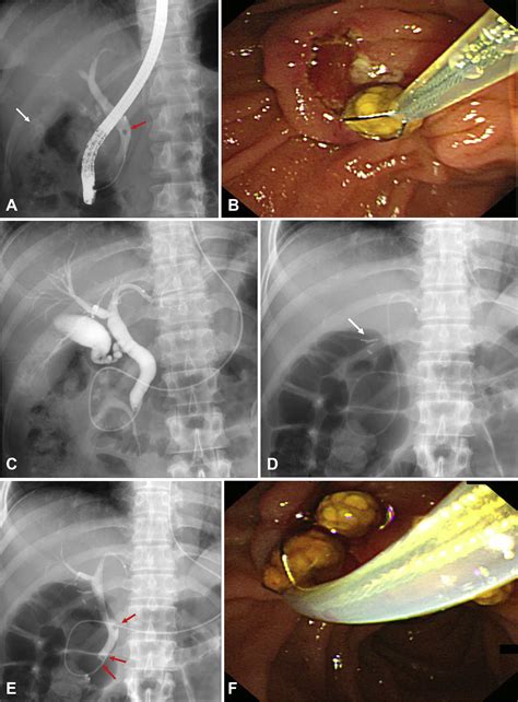 Incidence And Risk Factors For Postoperative Common Bile Duct Stones In