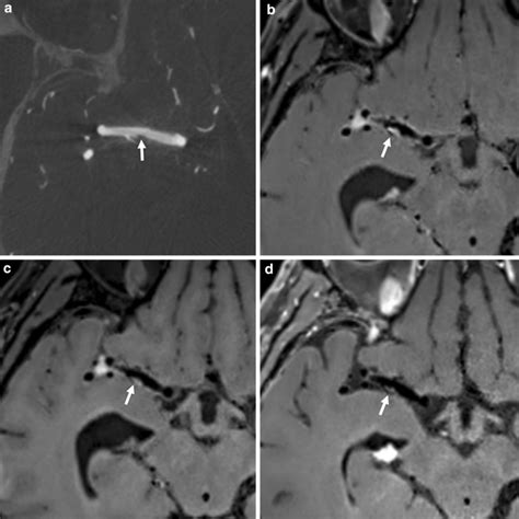 A 57 Year Old Man With Middle Cerebral Artery Dissection Indicated As