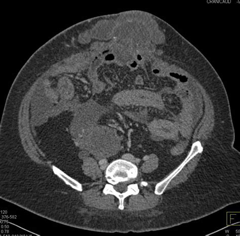 Ovarian Cancer With Carcinomatosis Obgyn Case Studies Ctisus Ct