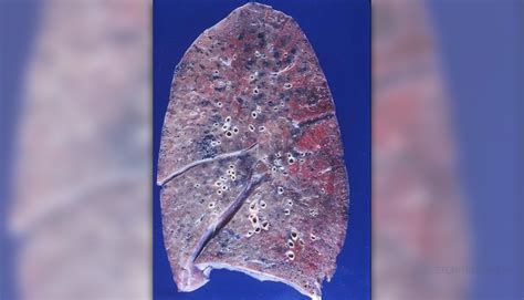 Emphysema Lung Disease General Center