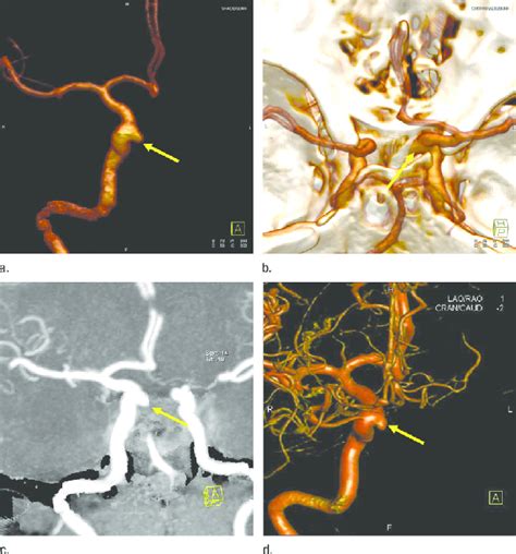 One Aneurysm In The Right Cavernous Segment Of Internal Carotid Artery Download Scientific