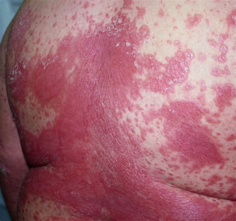 Plaque Psoriasis Pictures Symptoms Causes And Treatment