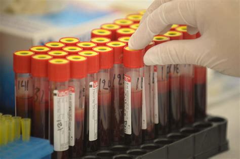 Análisis De Sangre Detecta Tumores 4 Años Antes Que Métodos Convencionales