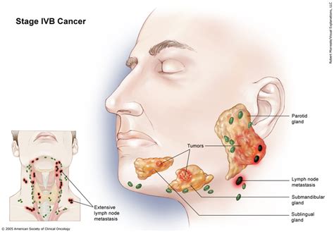 Cancer De Glandulas Salivales