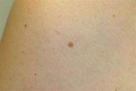 What does a normal mole look like. Skin cancer: what you should really be looking for - Netmums