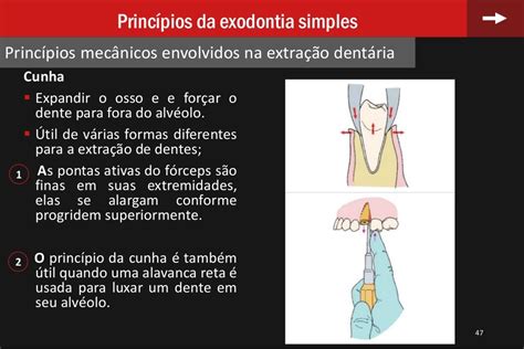 Exodontia Simples De Permanente