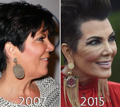 Kris Jenner Facelift Before And After Photo Kris Jenner Plastic