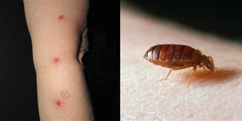 Pictures Of Bed Bugs Bites