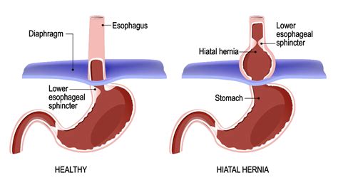 Hiatal Hernia Surgeon