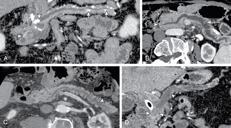 Cystic Pancreatic Lesions Radiology Key
