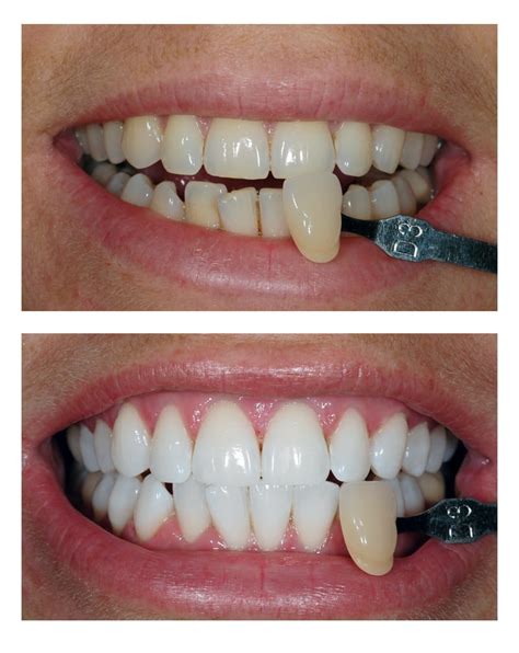 Teeth Whitening Bromley All Smiles Dental Tooth Whitening Bromley