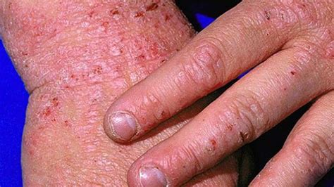 Skin Conditions Explained Warsoor