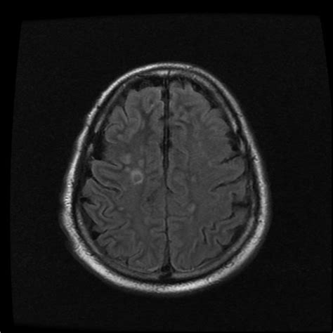Figure 3 MRI Image 3 Cerebral Gas Embolism A Serious Complication