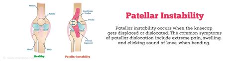 Patellar Instability Kneecap Dislocation Dislocation Of Patella