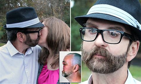 Man Kisses His Wife For First Time In Ten Years After Cancer Forced Him To Have Face
