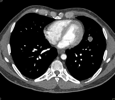 It is an expanded part of the gastrointestinal tract (gut) that plays an important role in the digestion of food. Lung Mass and Rib Metastases - Chest Case Studies - CTisus CT Scanning