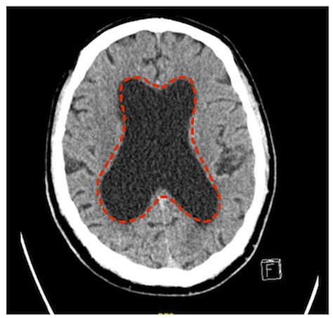 Cureus The Typical Triad Of Idiopathic Normal Pressure Hydrocephalus