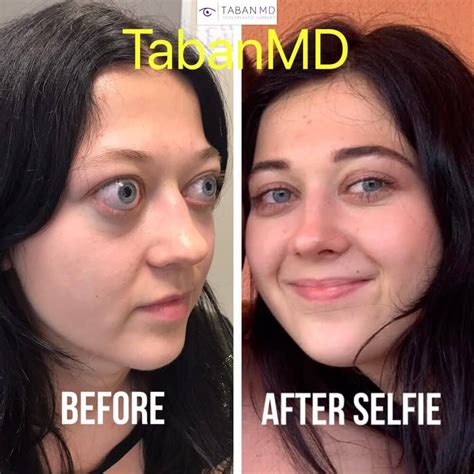 Thyroid Eye Disease Before And After My Xxx Hot Girl