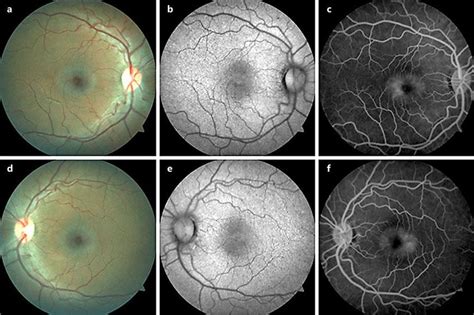 Fundus Photos Of The Initial Visit Of The Right Eye A And Left Eye