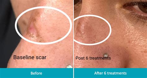 Intracel Acne Scar Treatment Montclair Nj Rf Microneedle System