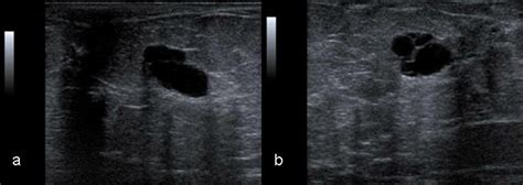 Figure 3 From Benign Breast Cyst Without Associated Gynecomastia In A