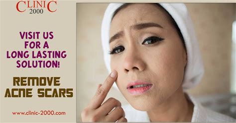 Frustated With Acne Scars Visit Clinic2000 For A Long Lasting Solution