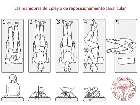 Maniobra De Epley reposicionamiento Canalicular Para Vértigo 10C