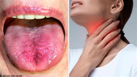 Como Saber Si Ya No Tengo Conjuntivitis - Placas en la garganta: síntomas y tratamiento - Mejor con Salud